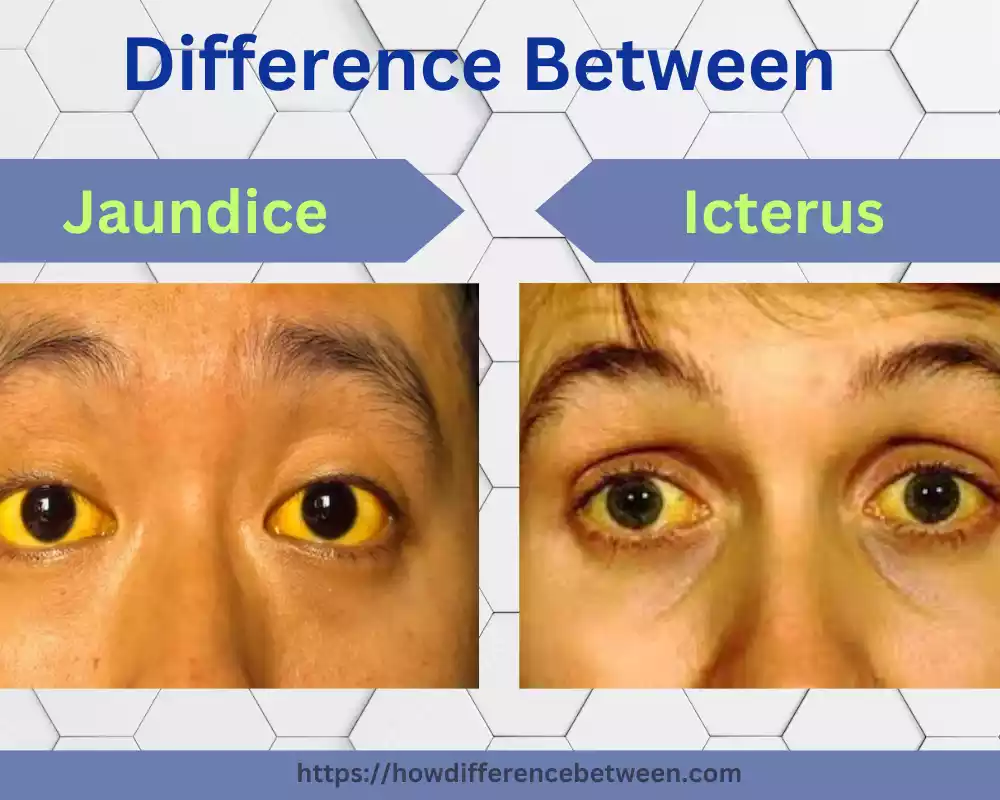 Icterus and Jaundice