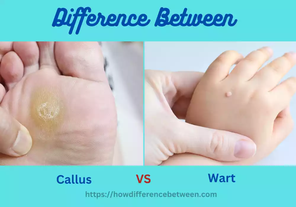 Callus and Wart