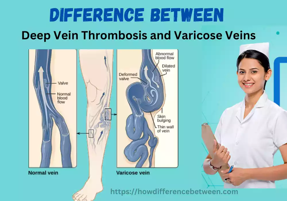 Deep Vein Thrombosis and Varicose Veins