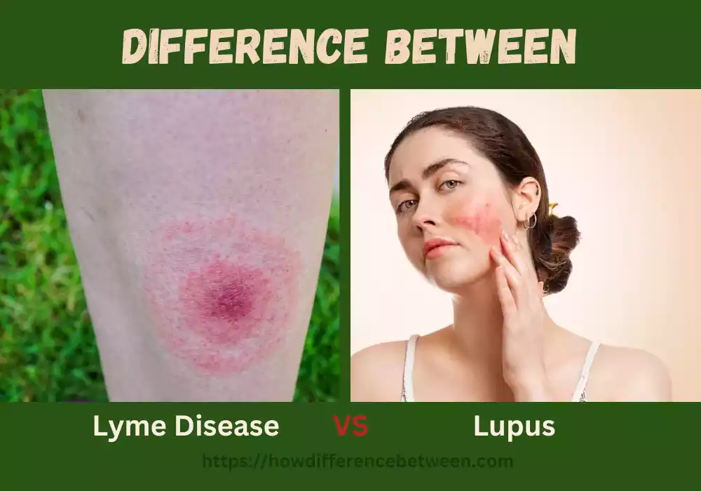 Lyme Disease and Lupus