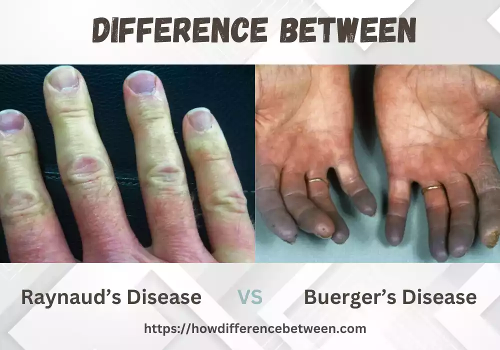 Raynaud and Buerger Disease