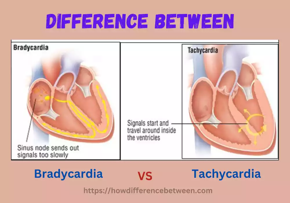 Tachycardia and Bradycardia