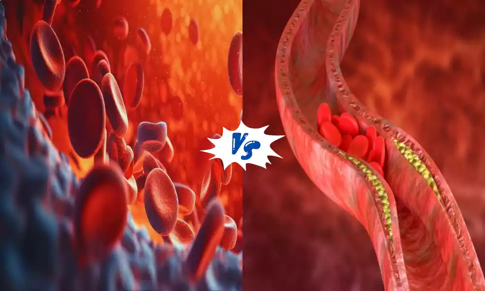 Atheroma and Thrombus