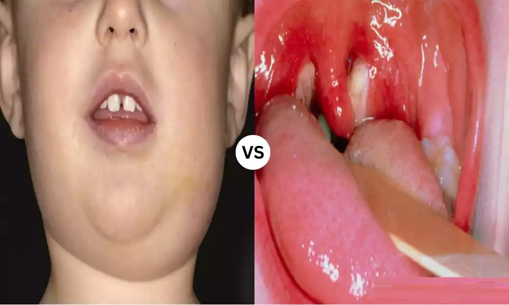 Mumps and Glandular Fever