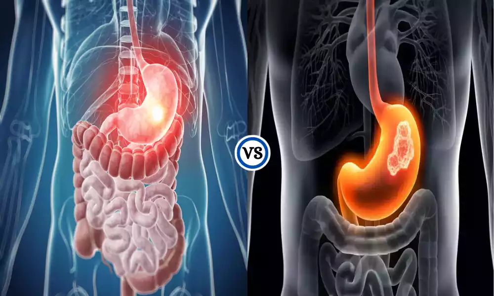 Gastritis and Stomach Cancer