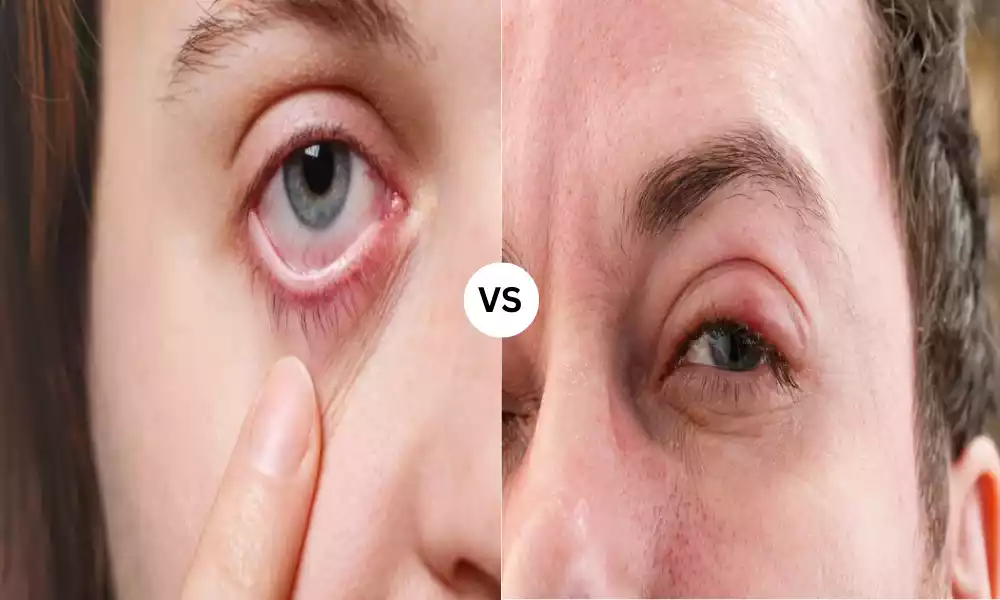 Glaucoma and Trachoma