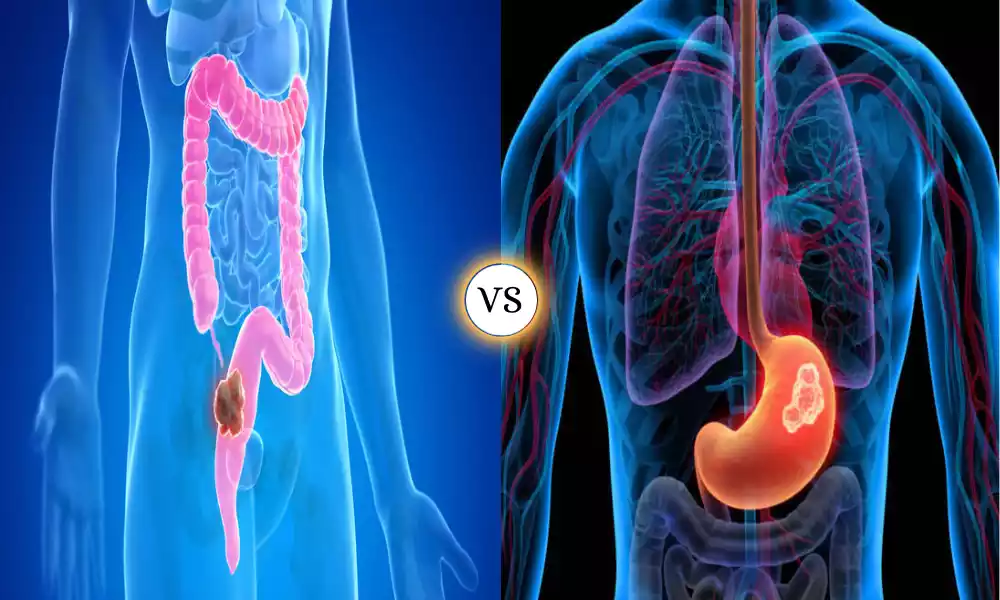 Intestinal and Diffuse Gastric Cancer