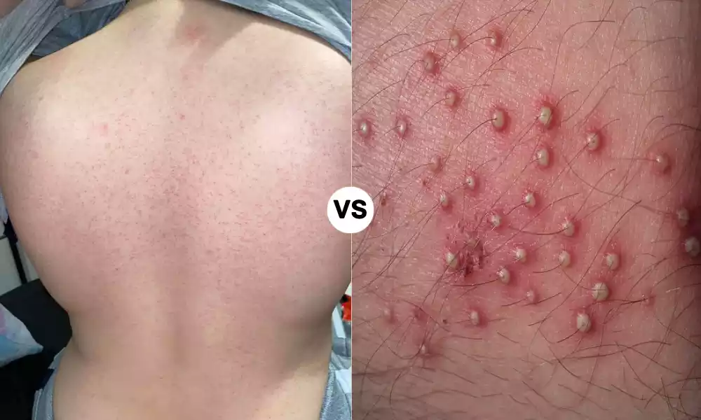 Keratosis Pilaris and Folliculitis