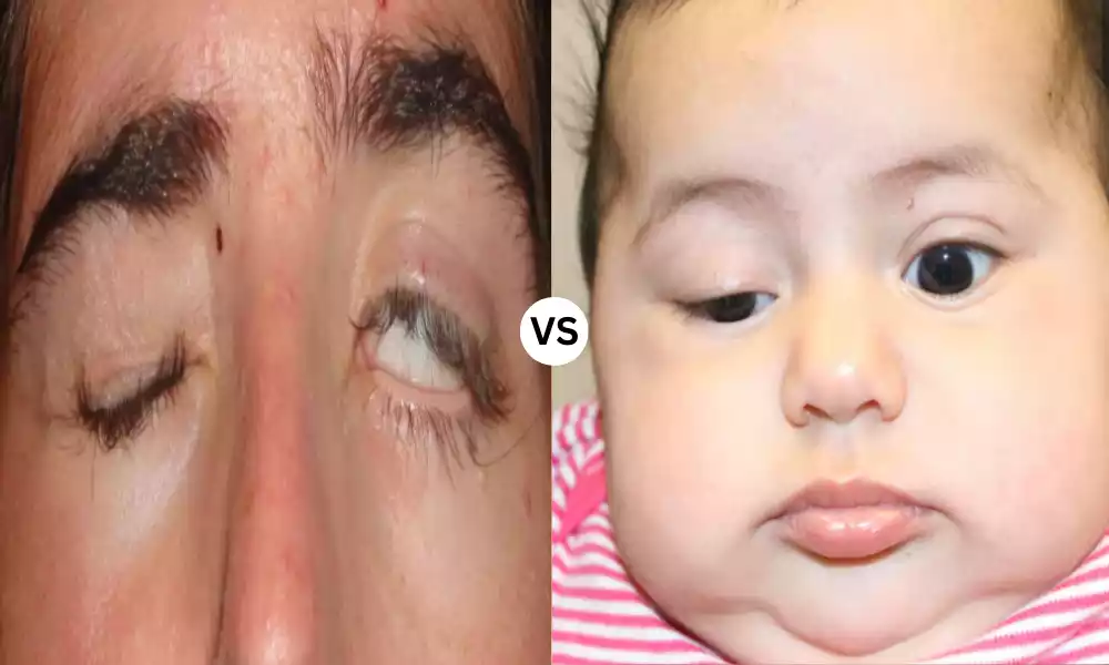 Lagophthalmos and Ptosis