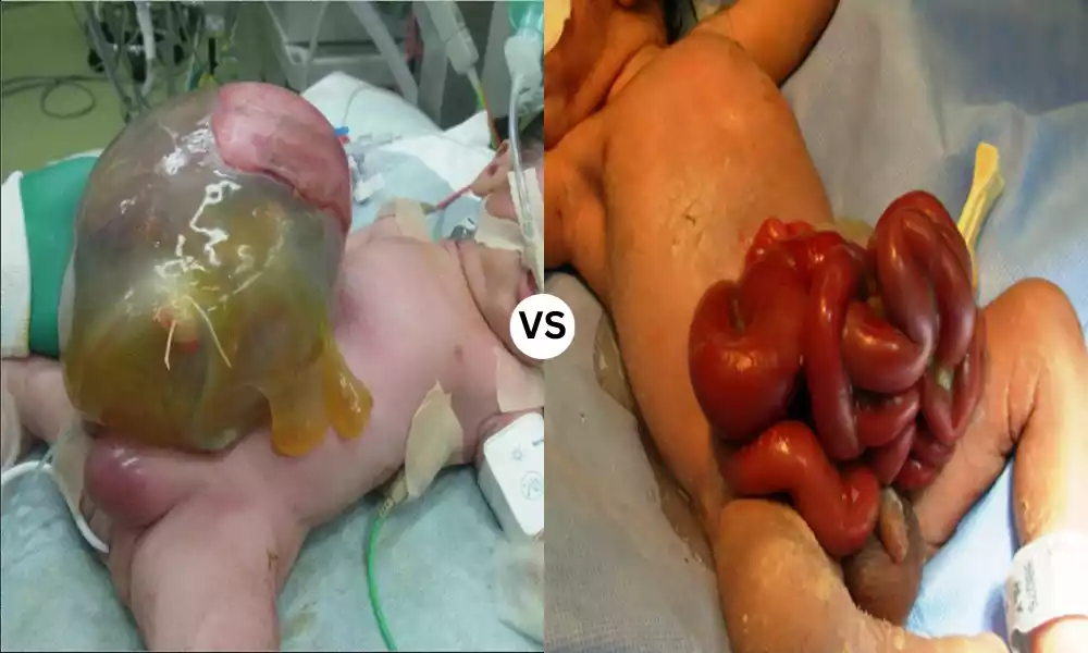 Omphalocele and Gastroschisis