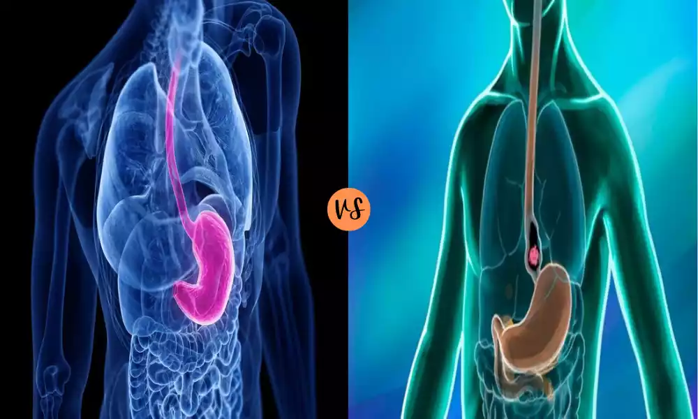 Achalasia and Esophageal Cancer