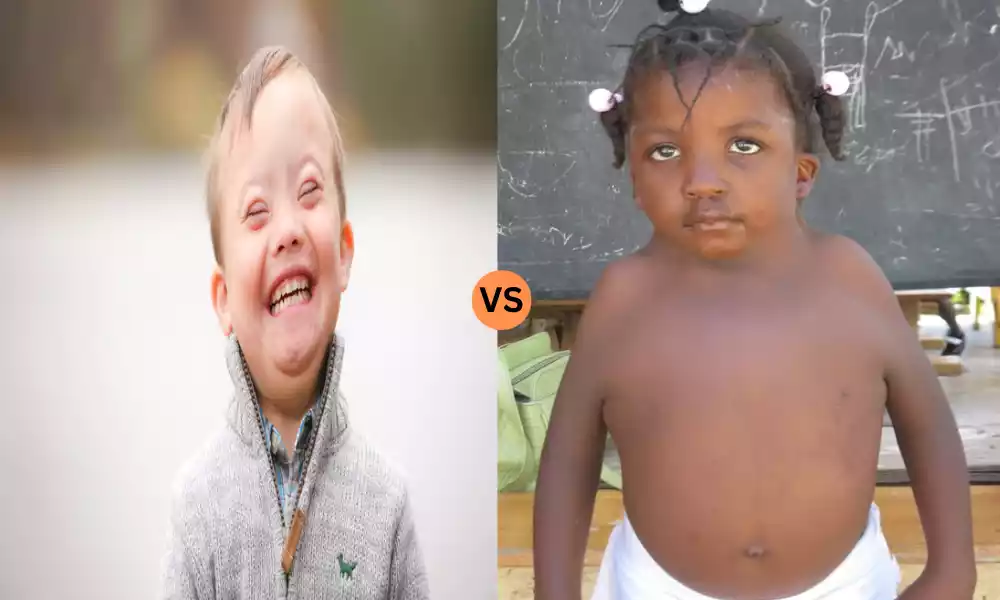 Down Syndrome and Turner Syndrome