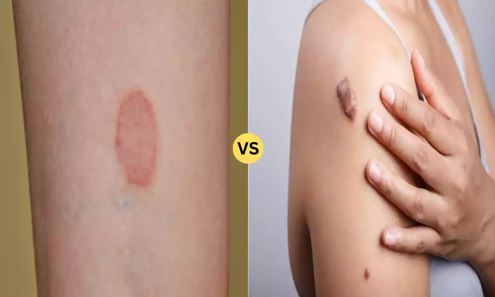 Granuloma and Keloid