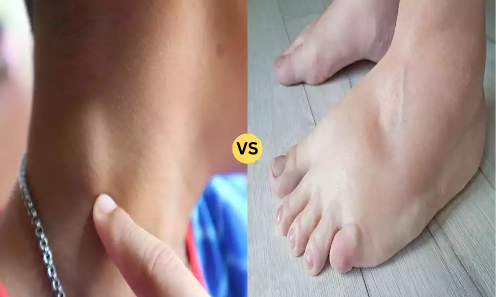 Lymphoma and Lymphedema