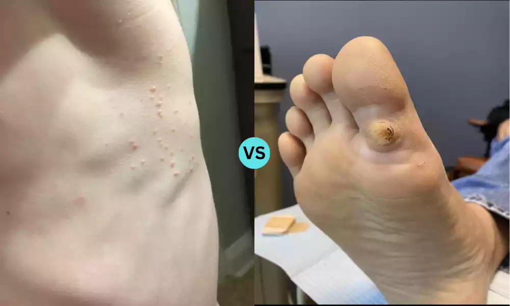 Molluscum Contagiosum and Warts
