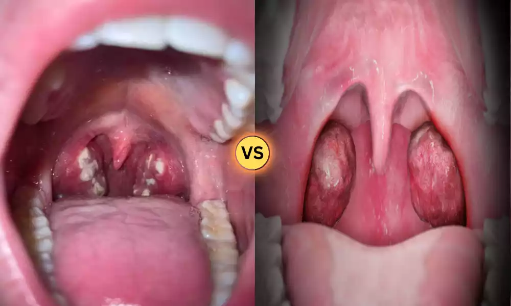 Mono and Tonsillitis