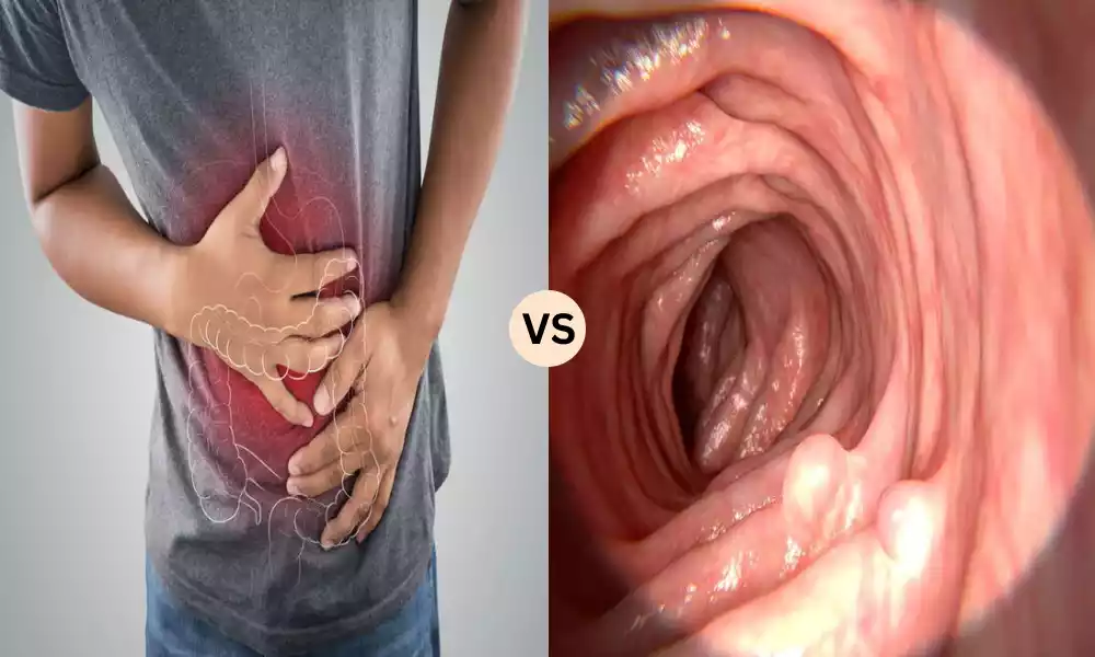 Neoplastic and Non-neoplastic Polyps