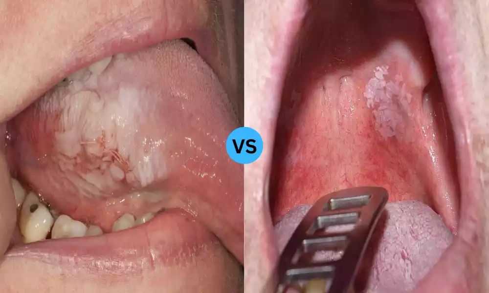 Tobacco Pouch Keratosis and Leukoplakia