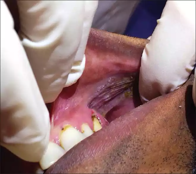 Tobacco Pouch Keratosis