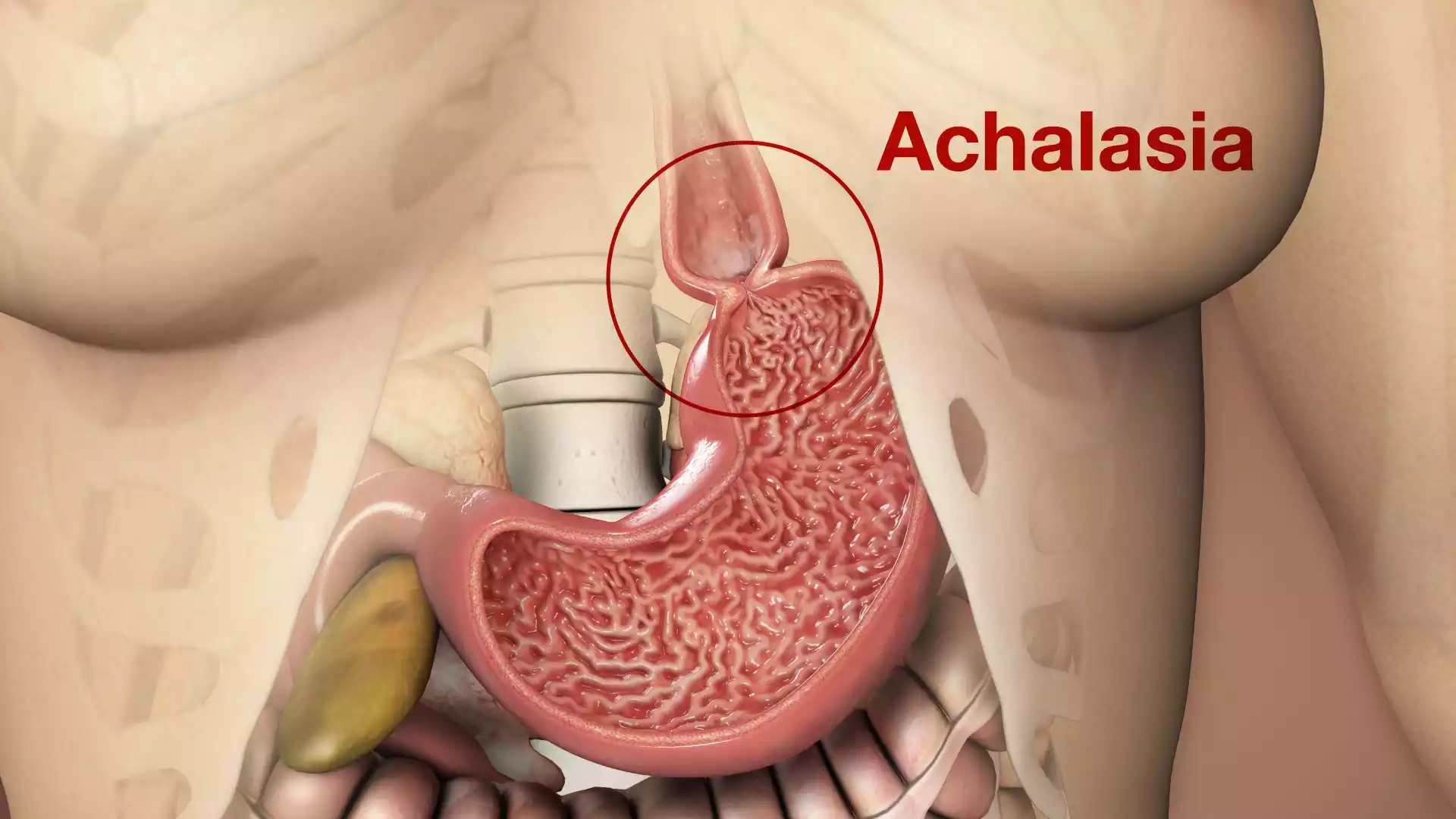 Achalasia