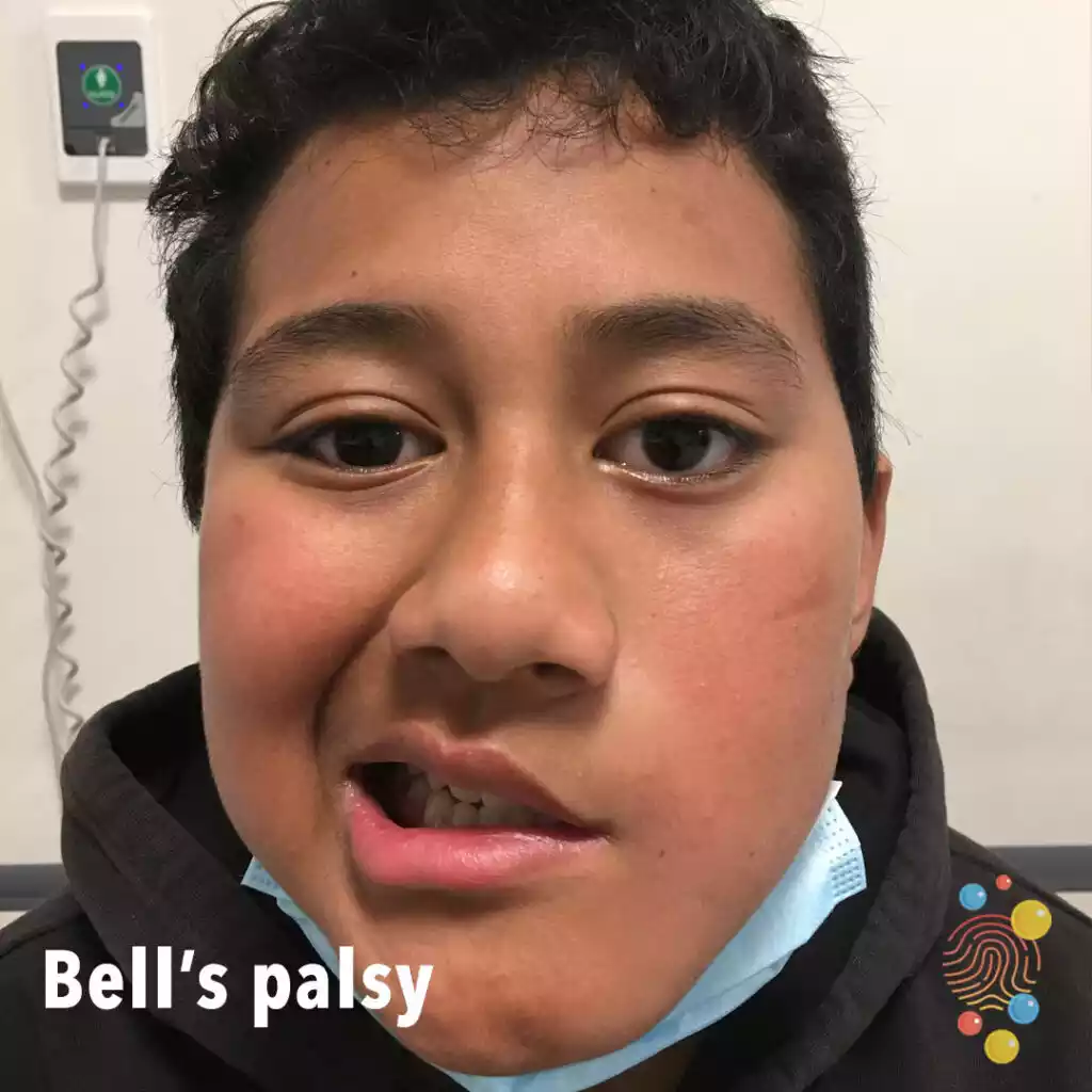 Bell's Palsy