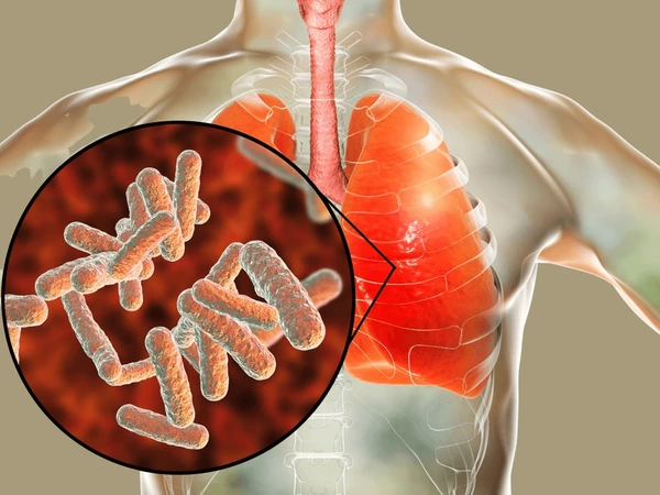 Bordetella Pertussis