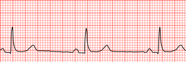 Bradycardia