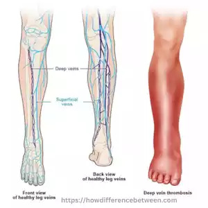 Deep Vein Thrombosis