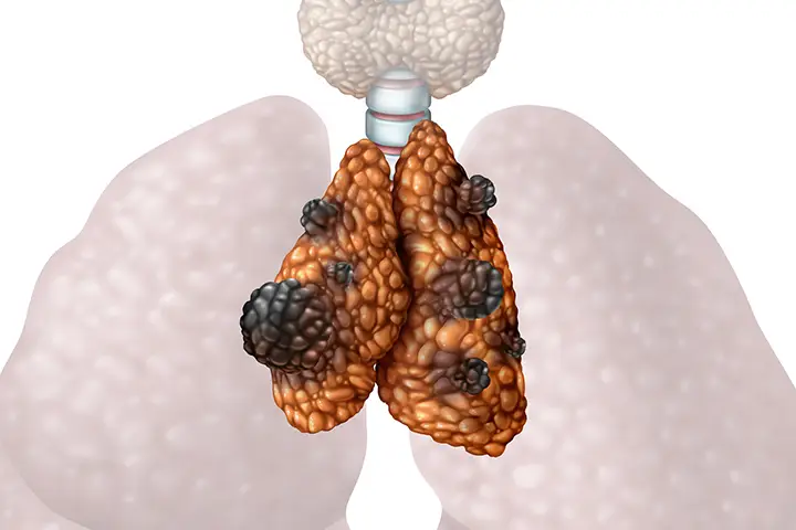 Definition and overview of Thymoma and Thymic Carcinoma