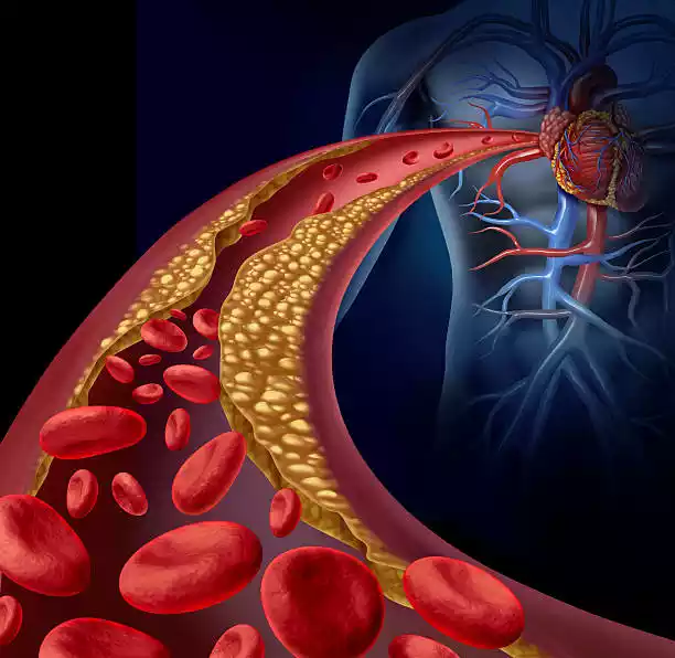 Definition of Atheroma