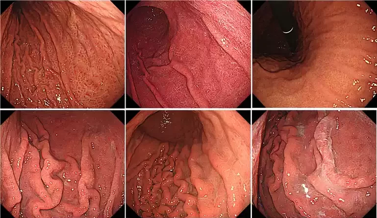 Diagnosis of Gastritis and Stomach Cancer