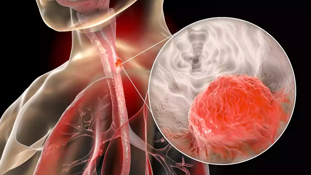 Esophageal Cancer