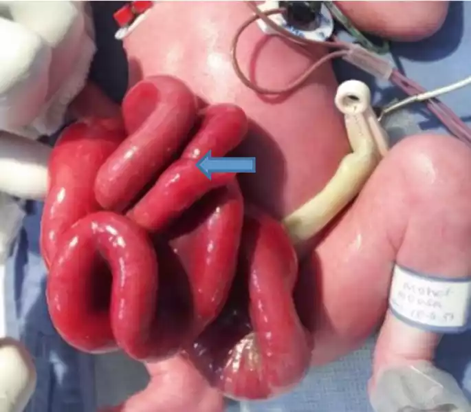 Gastroschisis