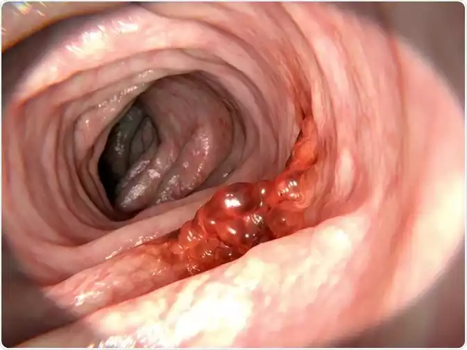 Intestinal Cancer