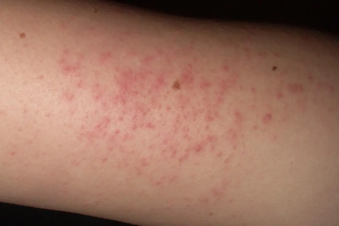 Keratosis Pilaris