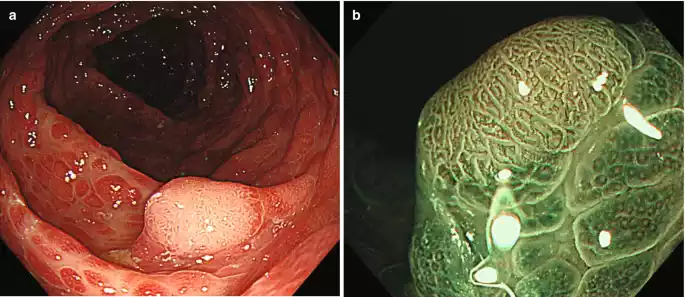 Neoplastic Polyps