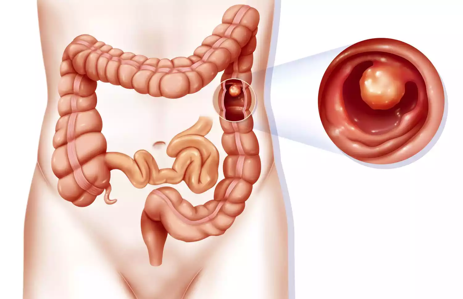 Non-neoplastic Polyps