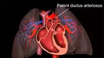 Patent Ductus Arteriosus