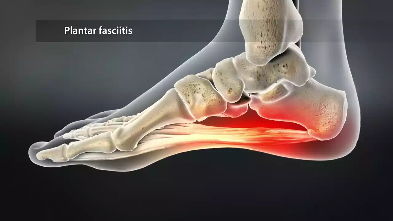 Plantar Fasciitis