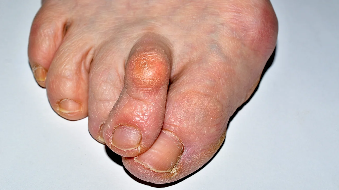 Psoriatic Arthritis