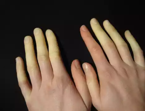 Raynaud's Disease