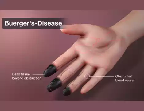 Buerger's Disease