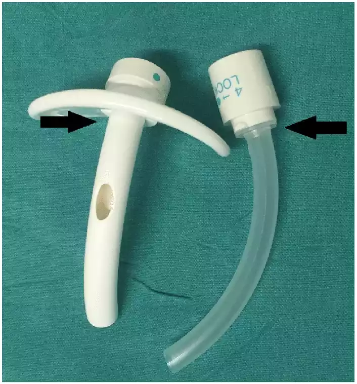 Similarities between Fenestrated and Non-fenestrated Tracheostomy Tube