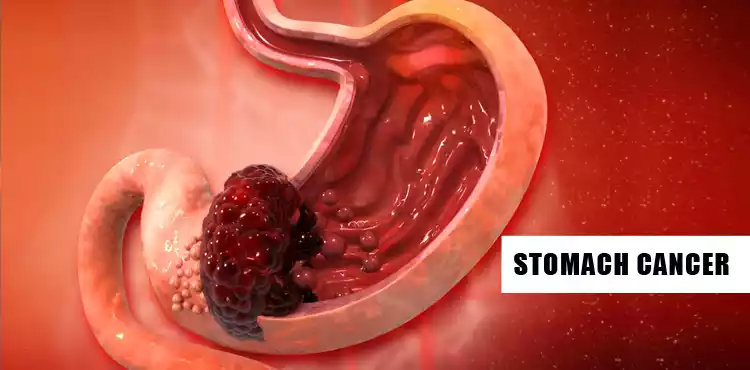 Stomach Cancer