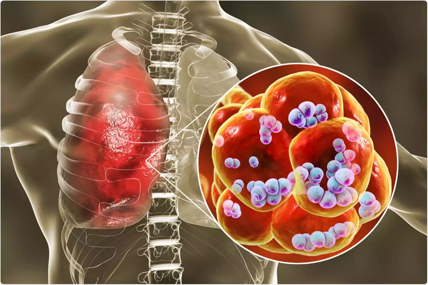 Streptococcus Pneumoniae