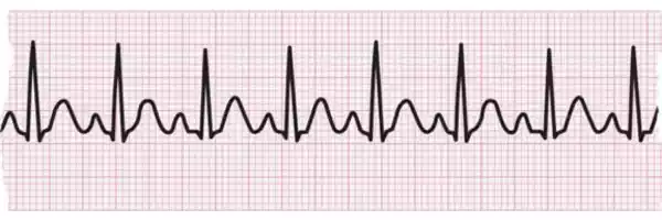 Tachycardia