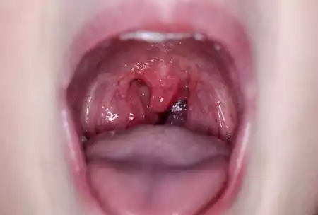 Tonsillitis