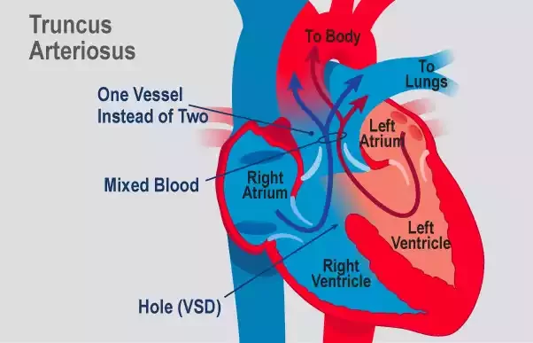 Truncus Arteriosus