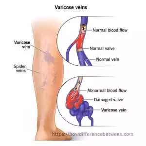 Varicose Veins