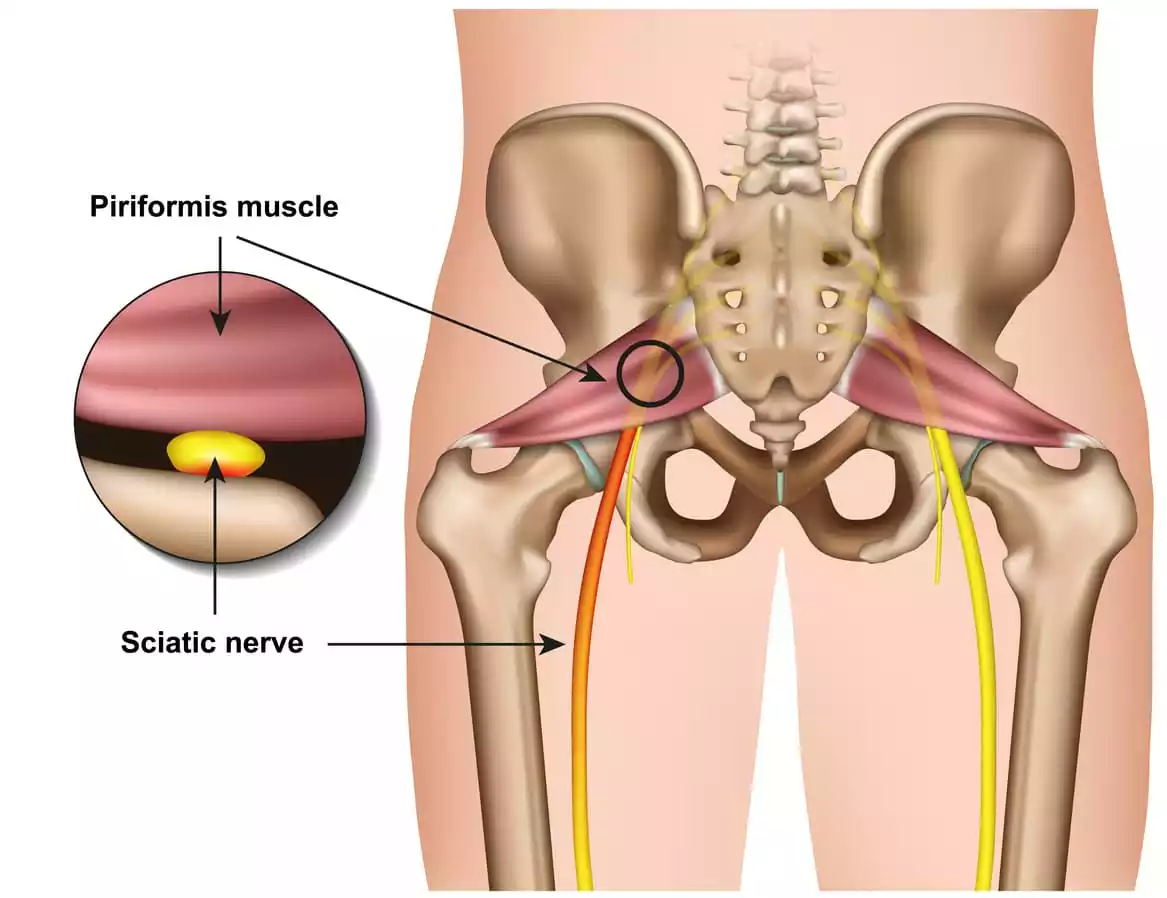 What is Piriformis Syndrome?